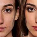 Enhance Your Profile With Non-Surgical Rhinoplasty Chiswick