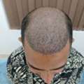 Hair Transplant Clinic In Odisha