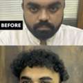 Ahmedabad Hair Transplant