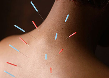 Toronto, Health, Acupuncture Etobicoke