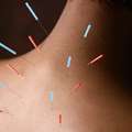 Acupuncture Etobicoke