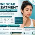 INR 15000,  Acne  Treatment In Andheri West, Mumbai