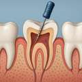 Best Root Canal Treatment In NIBM Pune | Expert Dentist