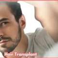 Best Clinic For Hair Transplant In Gurgaon - SB Trichology