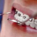 Teeth Extractions In Rosedale, MD | Gentle & Affordable Dental Care