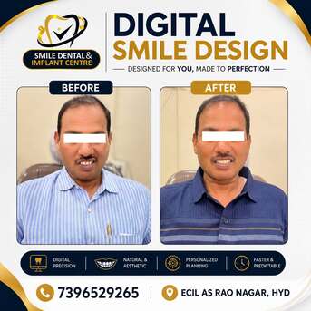 Hyderabad, Dental, Digital Smile Design Before And After | Smile Dental & Implant Centre