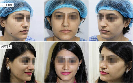 Mumbai, Health, Nose Reshaping In Andheri For Natural-Looking Results