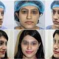 Nose Reshaping In Andheri For Natural-Looking Results