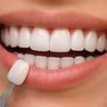 Composite Veneers In Azle TX | Azle Smiles