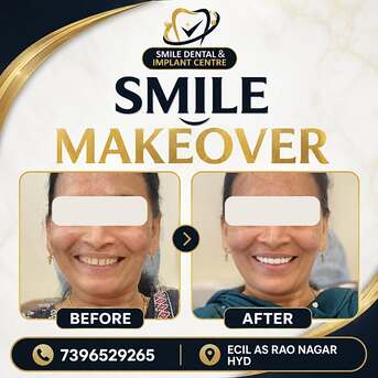 Hyderabad, Dental, Get Your Dream Smile! Custom Smile Makeovers At Smile Dental & Implant Centre