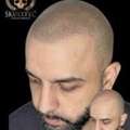 Hair Tattoo & Scalp Micropigmentation For Men | Skulltec Scalp Micro Pigmentation Ltd
