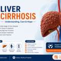 Understanding Liver Cirrhosis For Better Long-Term Liver Health