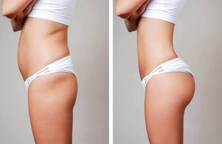 Mumbai, Health, Get A Slimmer Shape With Liposuction In Mumbai