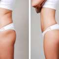Get A Slimmer Shape With Liposuction In Mumbai
