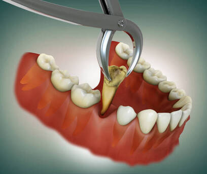 Pune, Dental, Best Tooth Extraction In NIBM Pune | Expert Dentist