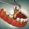 Best Tooth Extraction In NIBM Pune | Expert Dentist