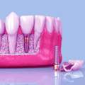 Dental Implants In Dwarka | Best Dentist In Dwarka Delhi &ndash; Samadhan Clinic