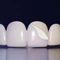 Teeth Whitening In Dwarka Delhi | Best Teeth Whitening In Dwarka Delhi