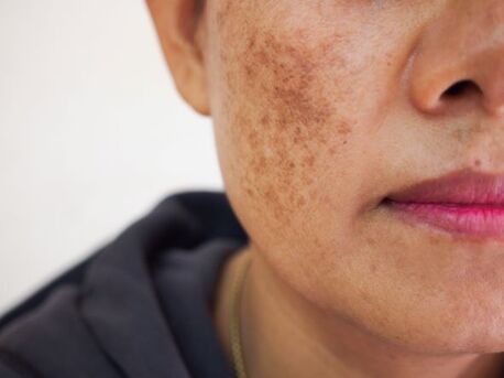 New York, Health, Hyperpigmentation Treatment Tampa For Even Skin Tone