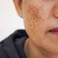 Hyperpigmentation Treatment Tampa For Even Skin Tone