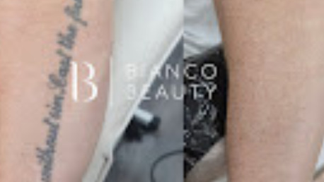 Manchester, Business, Tattoo Removal Manchester | Expert Laser Treatments At Bianco Beauty