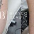 Tattoo Removal Manchester | Expert Laser Treatments At Bianco Beauty