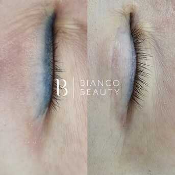 Manchester, Business, Tattoo Removal Manchester | Expert Laser Treatments At Bianco Beauty