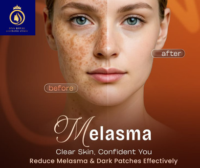 Thane, Fashion & Design, Trusted Clinic For The Best Melasma Treatment In Thane | DNA Royal.
