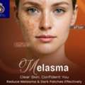 Trusted Clinic For The Best Melasma Treatment In Thane | DNA Royal.