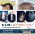 See Natural Results With Advanced Hair Transplant Surgery