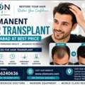 Expert Hair Transplant & Restoration Clinic Ahmedabad