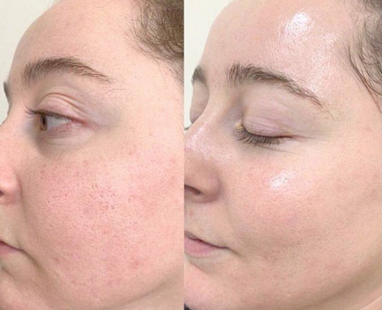 Mississauga, Business, Effective Melasma Treatment Mississauga For Clear Even Skin