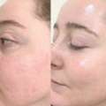 Effective Melasma Treatment Mississauga For Clear Even Skin