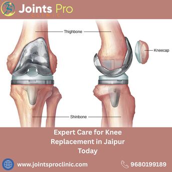 Jaipur, Health, Expert Care For Knee Replacement In Jaipur Today