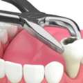 Tooth Extraction In NIBM Pune | Safe & Painless Dental Care
