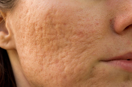 Noida, Health, Acne Scar Treatment In Noida | Expert Skin Care