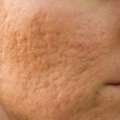 Acne Scar Treatment In Noida | Expert Skin Care
