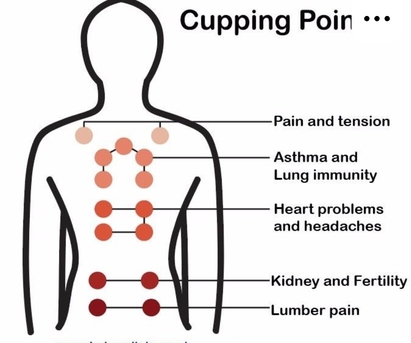 Riyadh, Beautician, Hijama (Cupping Therapy)