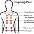 Hijama (Cupping Therapy)