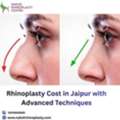 Rhinoplasty Cost In Jaipur With Advanced Techniques