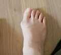 Benefits Of Treating Bunions On Feet