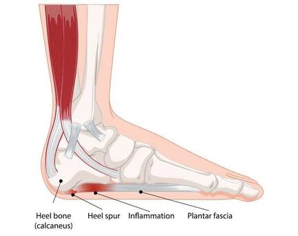 Singapore, Health, Comfort In Every Step: Overcoming Plantar Fasciitis In Singapore