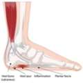 Comfort In Every Step: Overcoming Plantar Fasciitis In Singapore