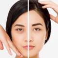 Dark Circles Treatment In Noida &ndash; Look Fresh And Well-Rested Again