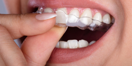 New Delhi, Health, Best Invisalign Cost In Gurgaon