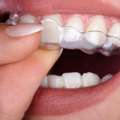 Best Invisalign Cost In Gurgaon