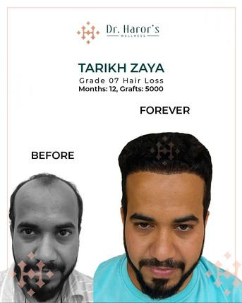New Delhi, Health, World-Class Hair Transplant, Budget-Friendly Price!