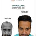 World-Class Hair Transplant, Budget-Friendly Price!