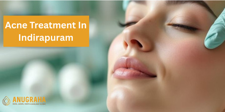 Mumbai, Health, Acne Treatment In Indirapuram | Dr. Monica Bambroo