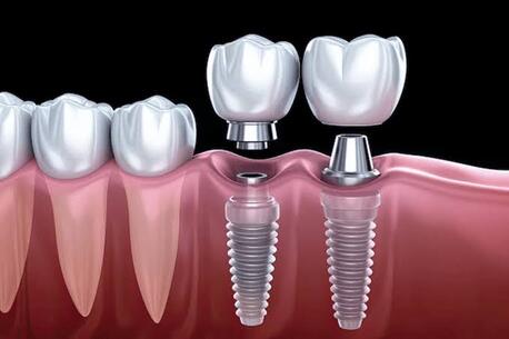 New Delhi, Dental, Dental Implants In Delhi NCR